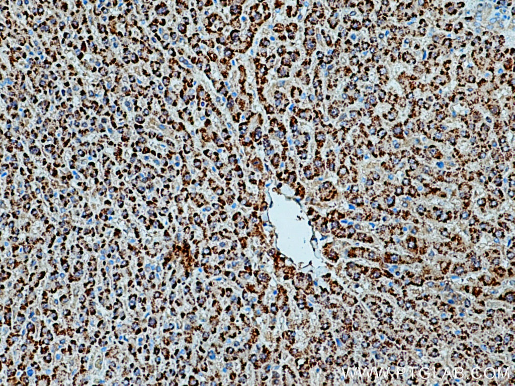 Immunohistochemistry (IHC) staining of human liver cancer tissue using Catalase Polyclonal antibody (21260-1-AP)