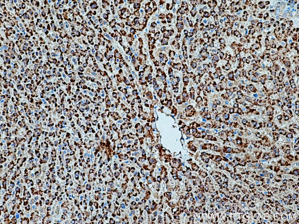 IHC staining of human liver cancer using 21260-1-AP