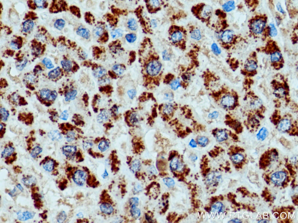 Immunohistochemistry (IHC) staining of human liver cancer tissue using Catalase Polyclonal antibody (21260-1-AP)