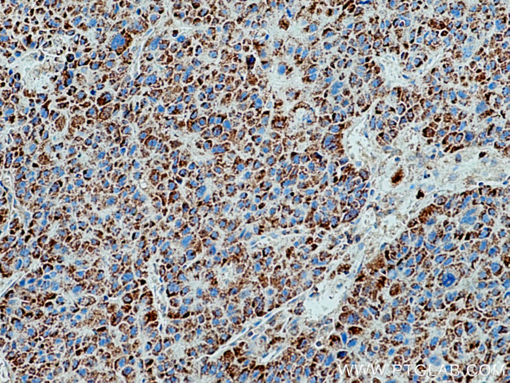 IHC staining of human liver cancer using 21260-1-AP