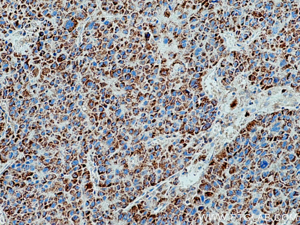 Immunohistochemistry (IHC) staining of human liver cancer tissue using Catalase Polyclonal antibody (21260-1-AP)