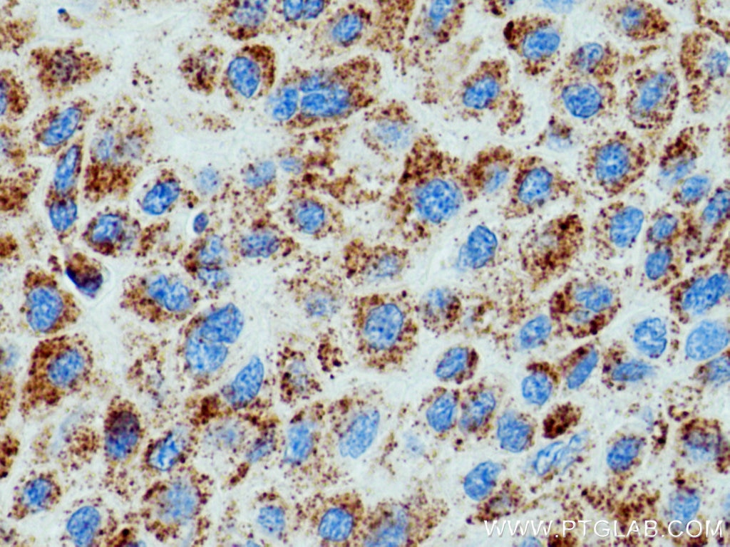 Immunohistochemistry (IHC) staining of human liver cancer tissue using Catalase Polyclonal antibody (21260-1-AP)