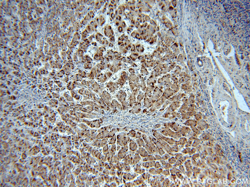 Immunohistochemistry (IHC) staining of human hepatocirrhosis tissue using Catalase Polyclonal antibody (21260-1-AP)