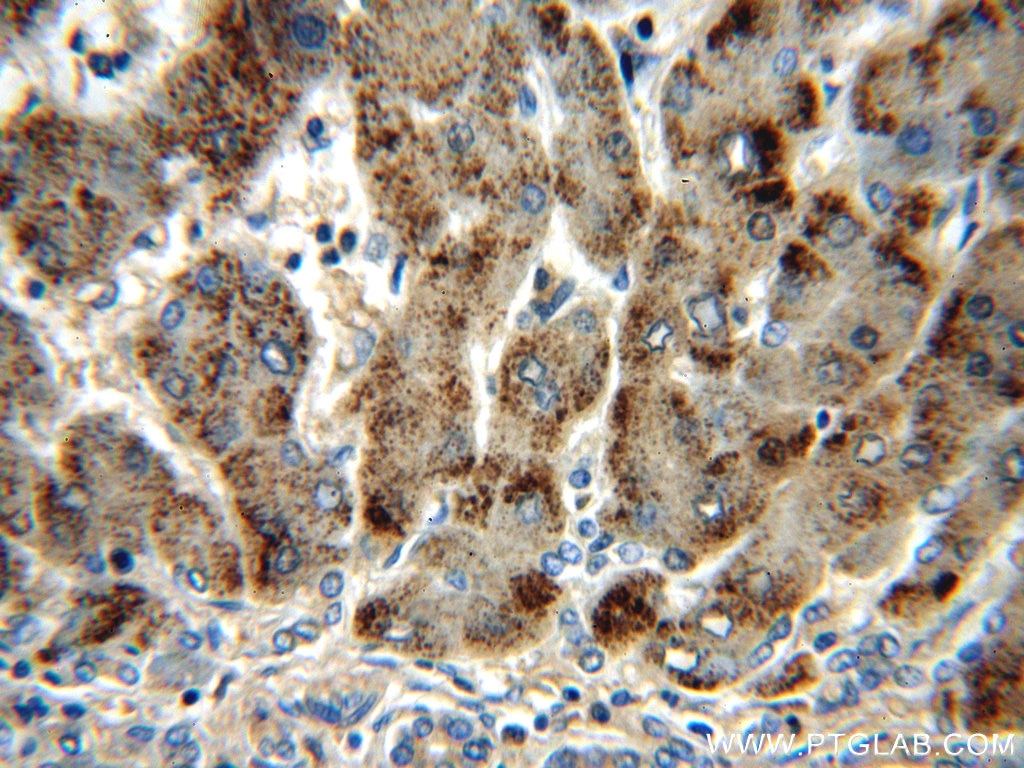 IHC staining of human hepatocirrhosis using 21260-1-AP