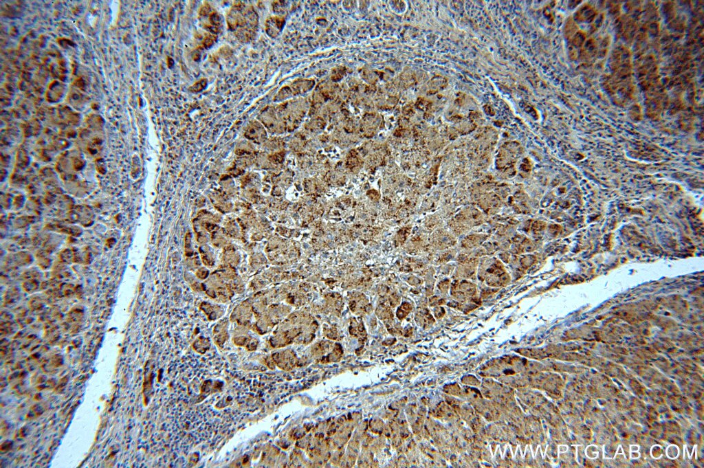 Immunohistochemistry (IHC) staining of human hepatocirrhosis tissue using Catalase-Specific Polyclonal antibody (19792-1-AP)