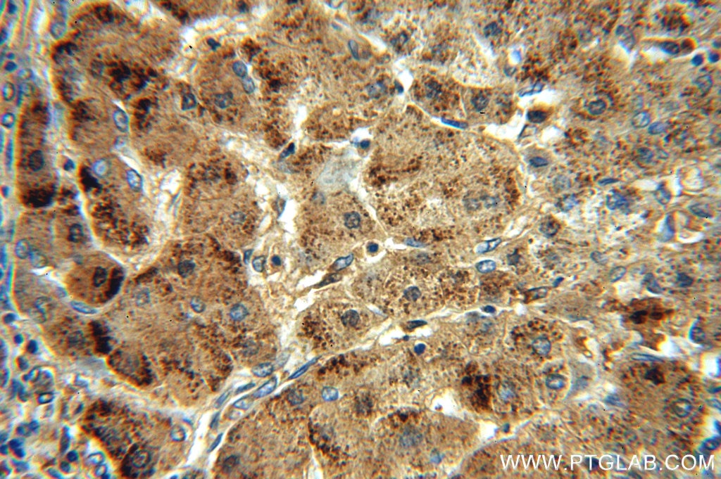 Immunohistochemistry (IHC) staining of human hepatocirrhosis tissue using Catalase-Specific Polyclonal antibody (19792-1-AP)