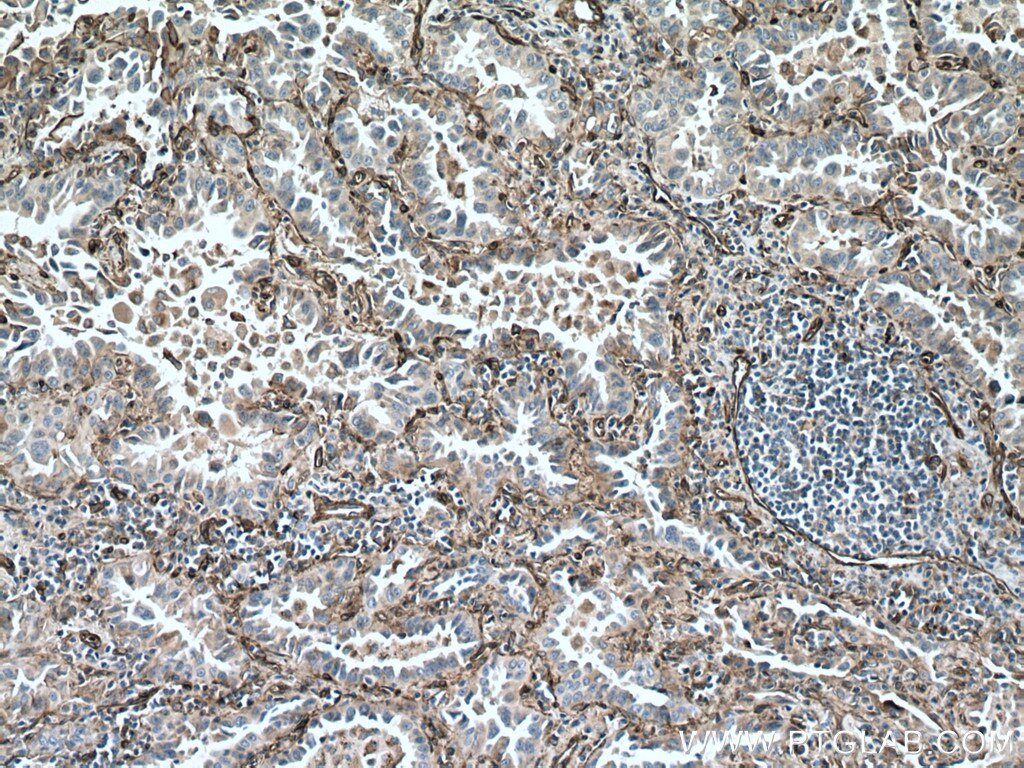 Immunohistochemistry (IHC) staining of human lung cancer tissue using Caveolin-1 Polyclonal antibody (16447-1-AP)