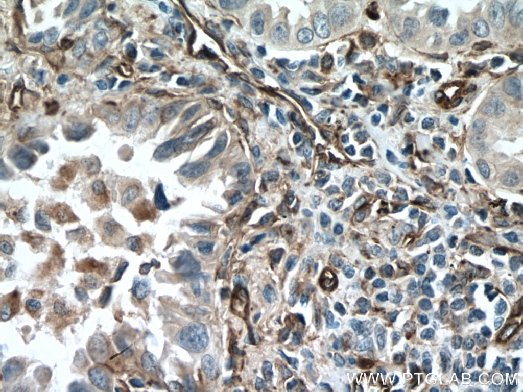 Immunohistochemistry (IHC) staining of human lung cancer tissue using Caveolin-1 Polyclonal antibody (16447-1-AP)