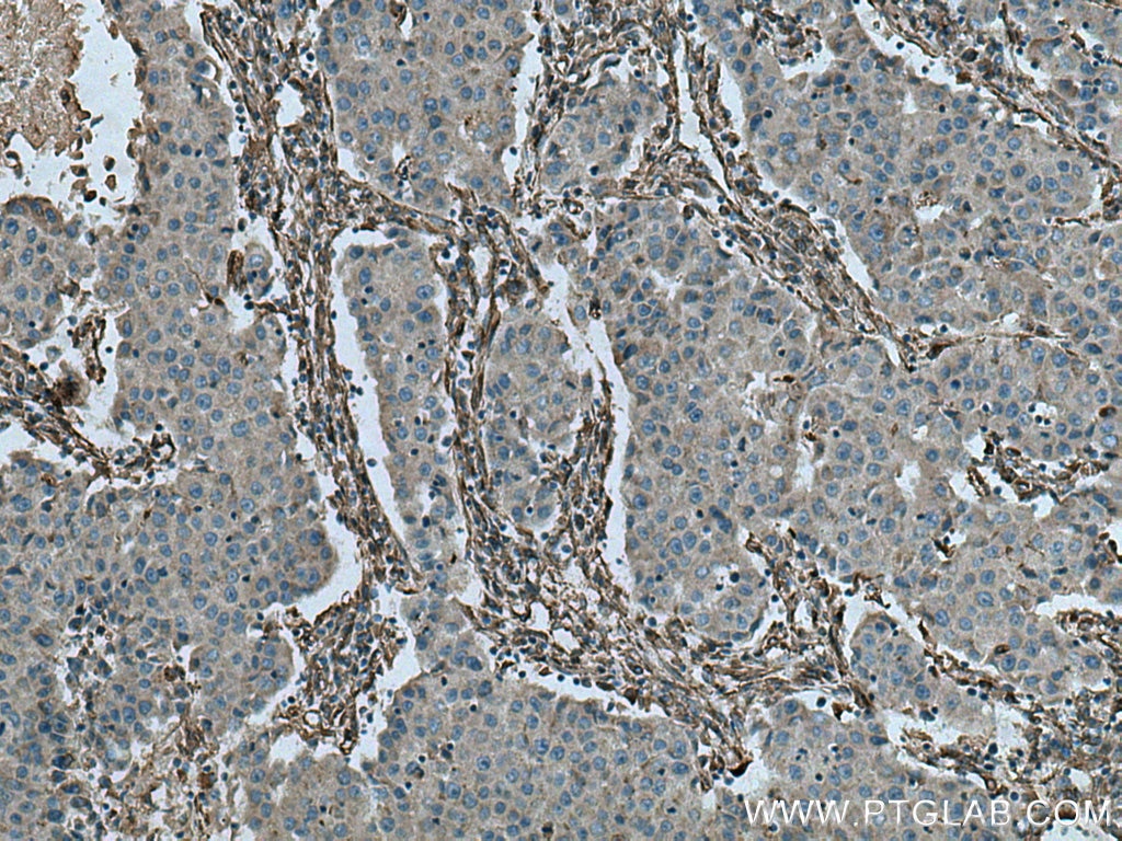Immunohistochemistry (IHC) staining of human breast cancer tissue using Caveolin-1 Polyclonal antibody (16447-1-AP)
