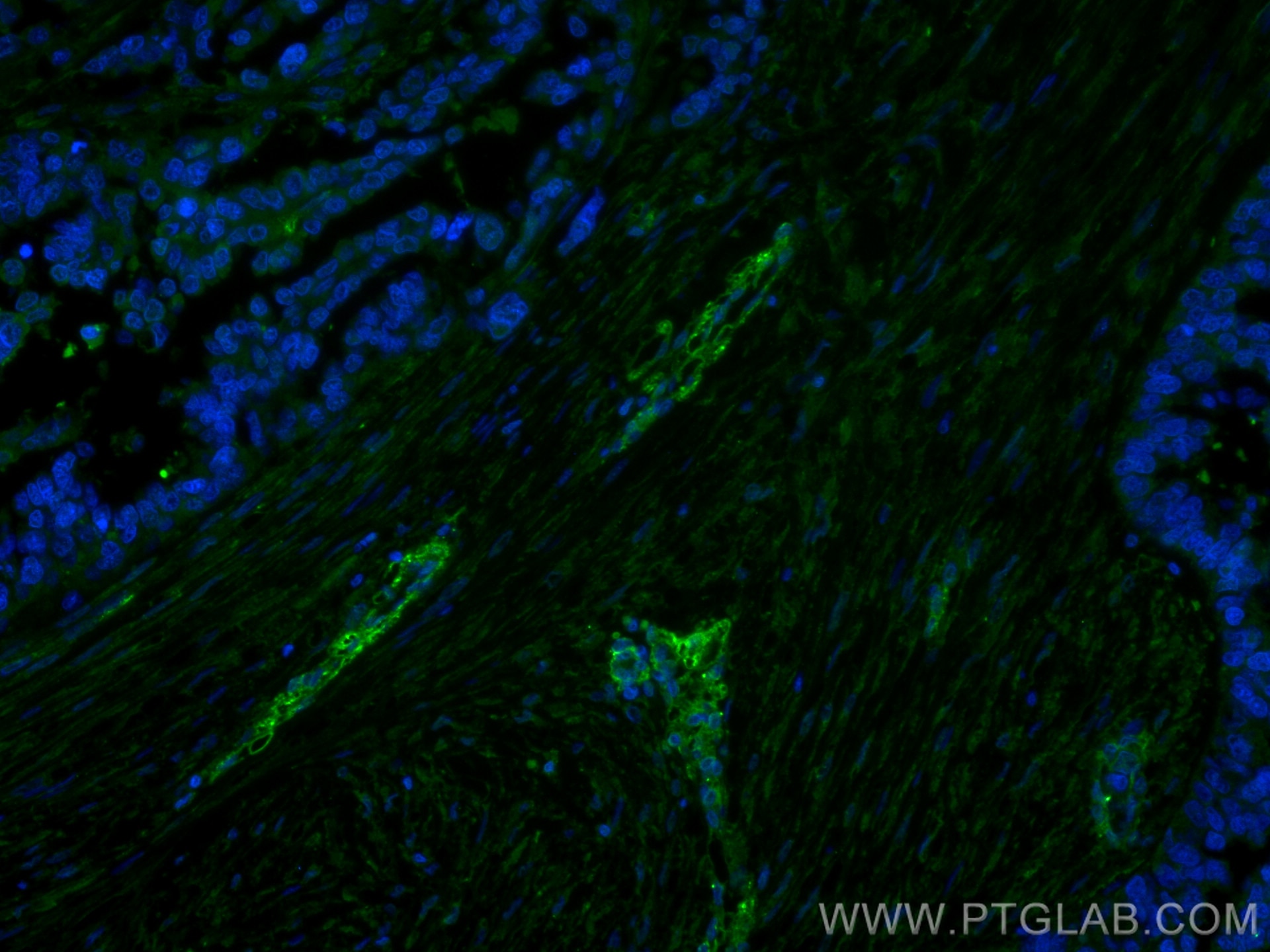 Immunofluorescence (IF) / fluorescent staining of human liver cancer tissue using Caveolin-1 Monoclonal antibody (66067-1-Ig)