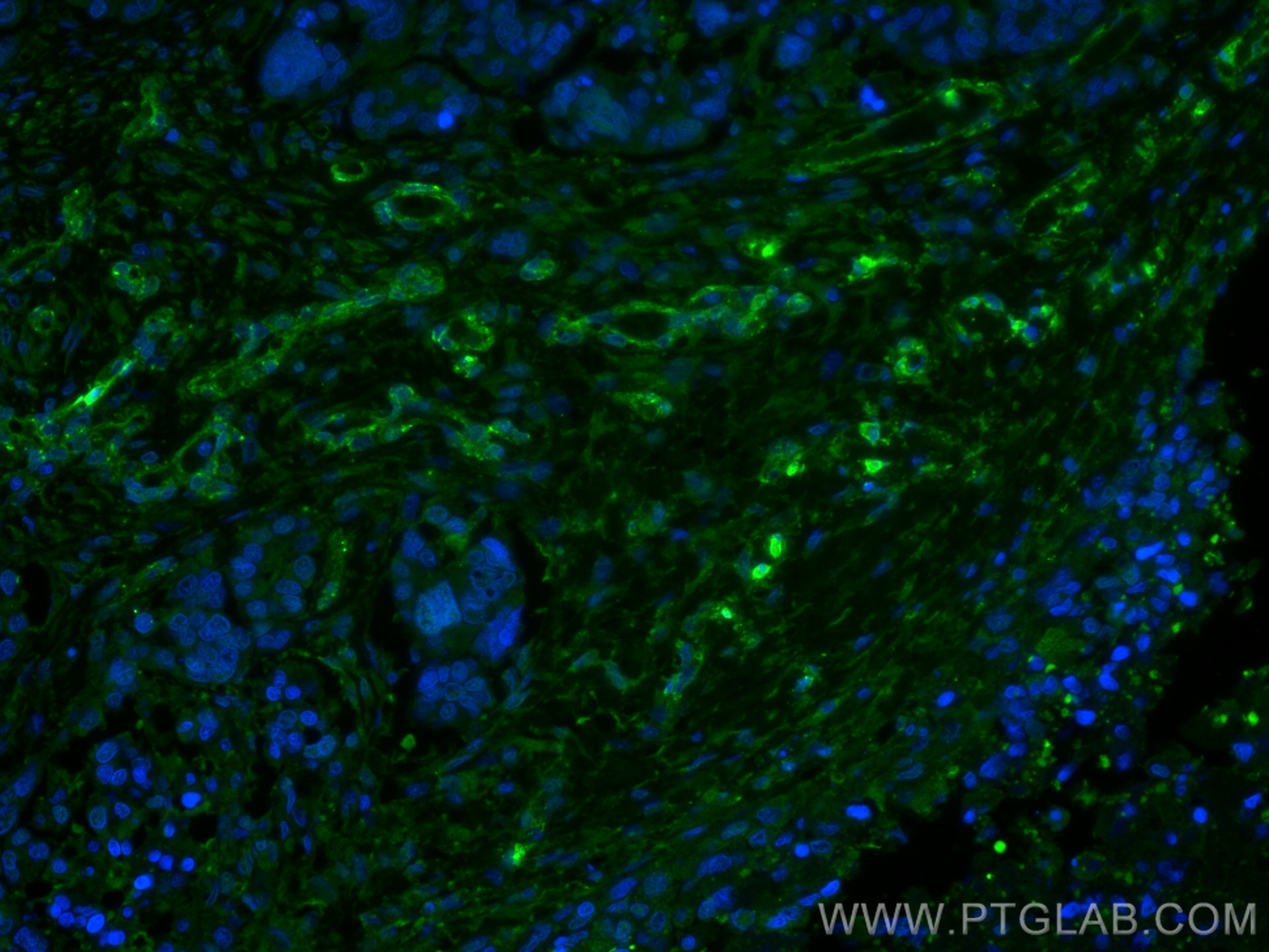 Immunofluorescence (IF) / fluorescent staining of human liver cancer tissue using Caveolin-1 Monoclonal antibody (66067-1-Ig)