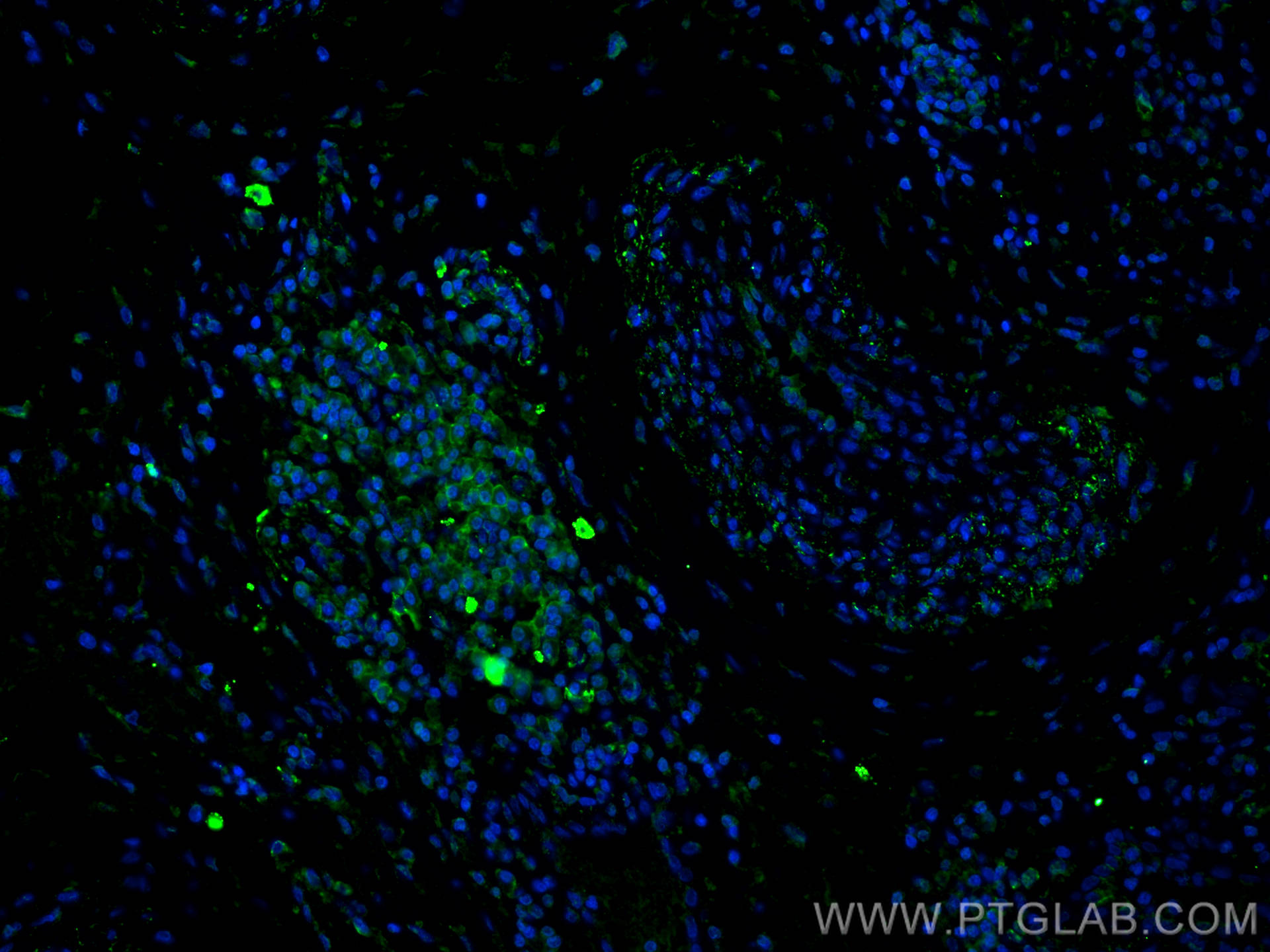 Immunofluorescence (IF) / fluorescent staining of human skin cancer tissue using Caveolin-1 Monoclonal antibody (66067-1-Ig)