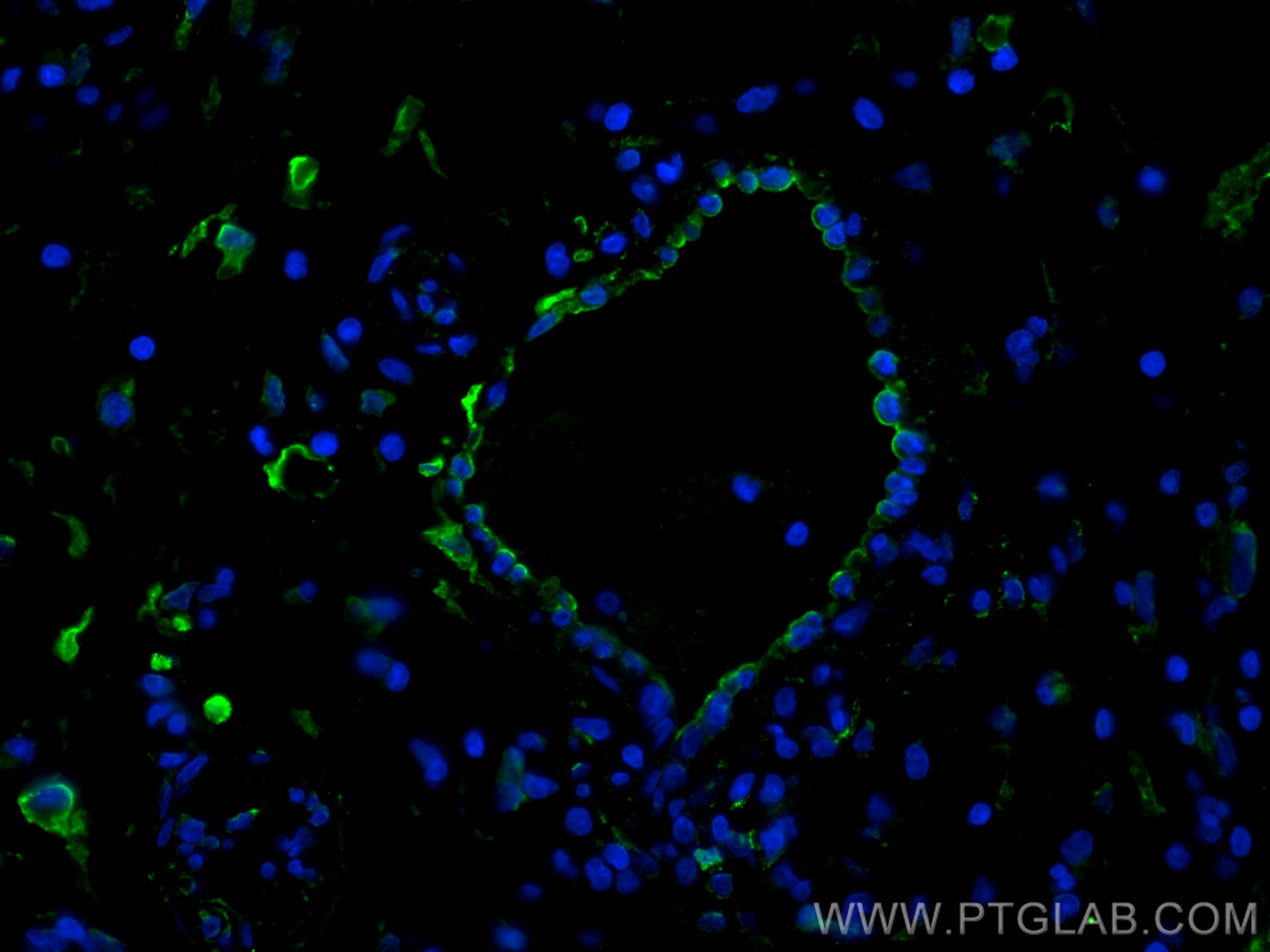 Immunofluorescence (IF) / fluorescent staining of human skin cancer tissue using Caveolin-1 Monoclonal antibody (66067-1-Ig)