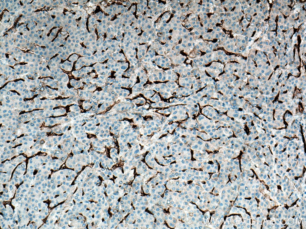 Immunohistochemistry (IHC) staining of human liver cancer tissue using Caveolin-1 Monoclonal antibody (66067-1-Ig)