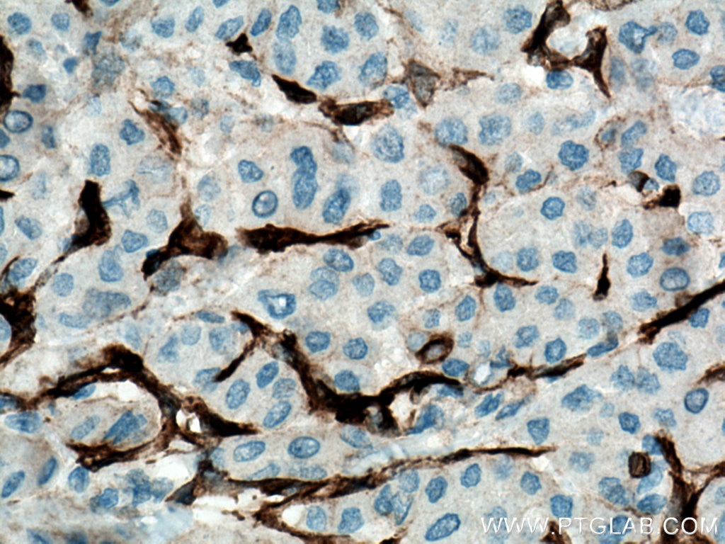 Immunohistochemistry (IHC) staining of human liver cancer tissue using Caveolin-1 Monoclonal antibody (66067-1-Ig)