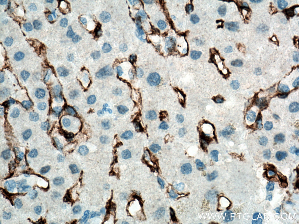 Immunohistochemistry (IHC) staining of human liver cancer tissue using Caveolin-1 Monoclonal antibody (66067-1-Ig)