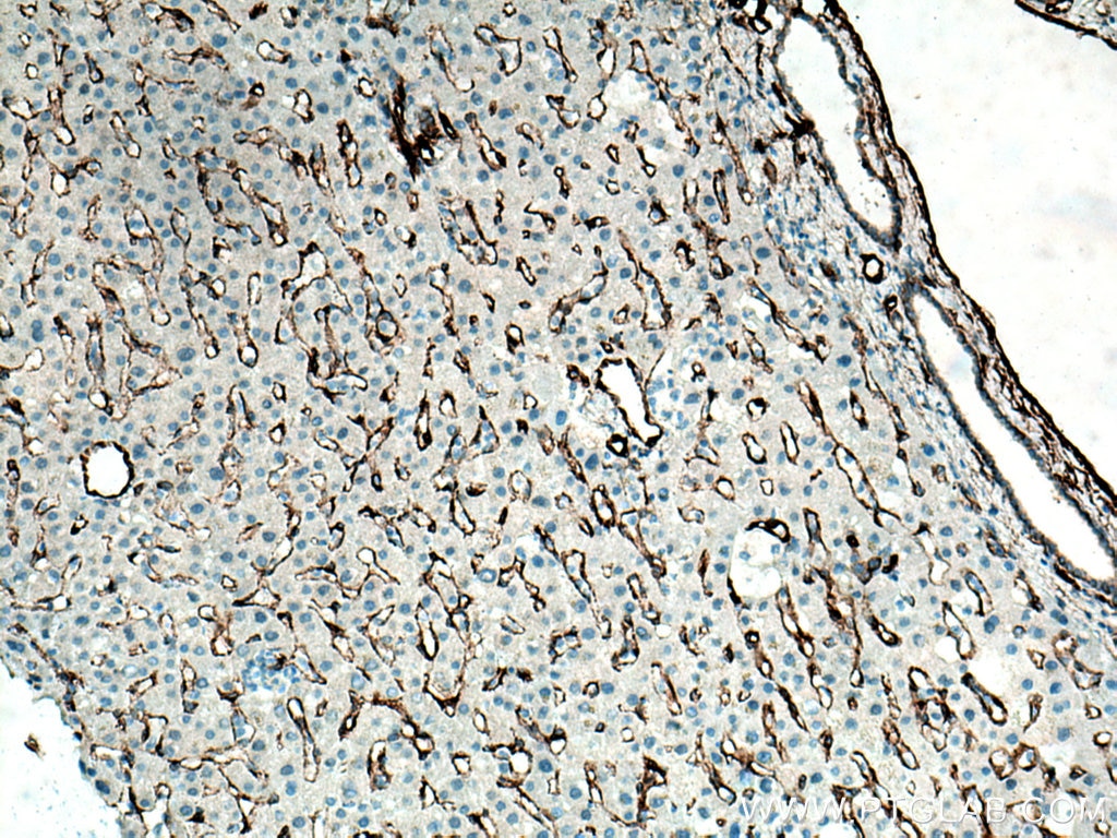 IHC staining of human liver cancer using 66067-1-Ig