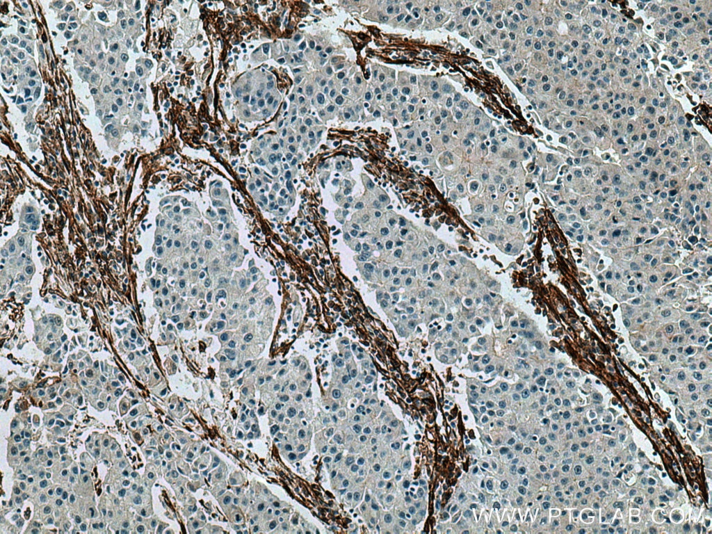 Immunohistochemistry (IHC) staining of human breast cancer tissue using Caveolin-1 Monoclonal antibody (66067-1-Ig)