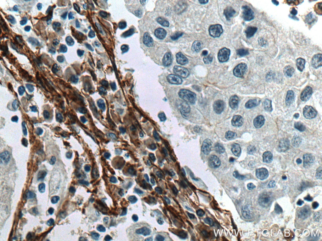 Immunohistochemistry (IHC) staining of human breast cancer tissue using Caveolin-1 Monoclonal antibody (66067-1-Ig)