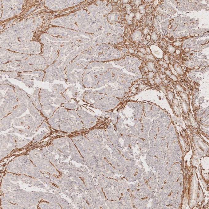 Immunohistochemistry (IHC) staining of human stomach cancer tissue using Caveolin-1 Monoclonal antibody (66067-1-Ig)