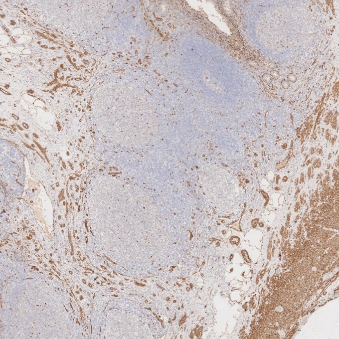 Immunohistochemistry (IHC) staining of human appendicitis tissue using Caveolin-1 Monoclonal antibody (66067-1-Ig)
