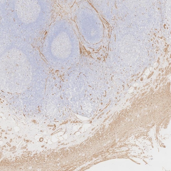 Immunohistochemistry (IHC) staining of human appendicitis tissue using Caveolin-1 Monoclonal antibody (66067-1-Ig)