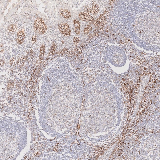 Immunohistochemistry (IHC) staining of human tonsillitis tissue using Caveolin-1 Monoclonal antibody (66067-1-Ig)