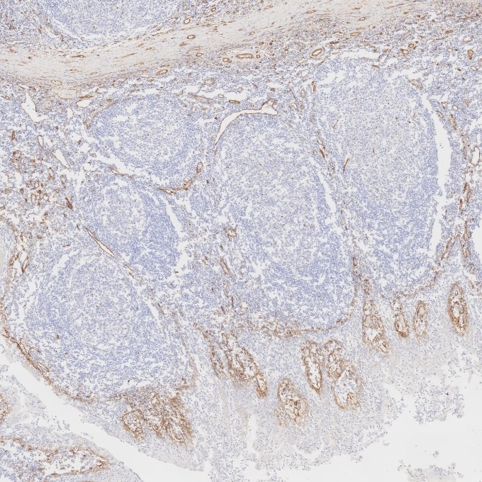 Immunohistochemistry (IHC) staining of human tonsillitis tissue using Caveolin-1 Monoclonal antibody (66067-1-Ig)