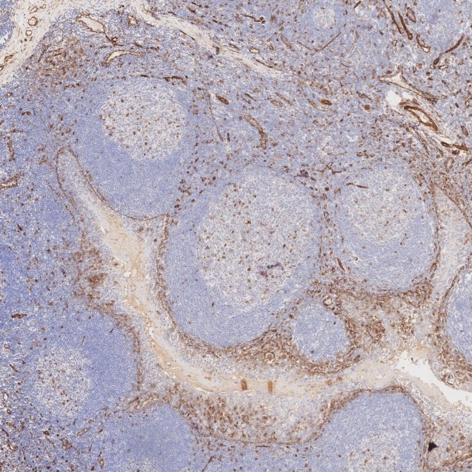 Immunohistochemistry (IHC) staining of human tonsillitis tissue using Caveolin-1 Monoclonal antibody (66067-1-Ig)