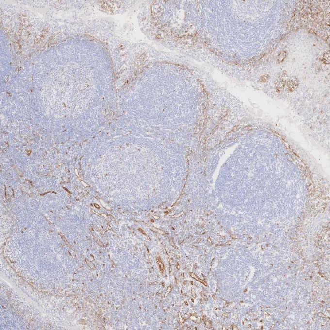 Immunohistochemistry (IHC) staining of human tonsillitis tissue using Caveolin-1 Monoclonal antibody (66067-1-Ig)