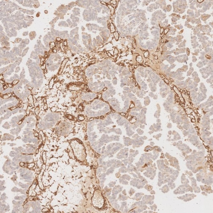 Immunohistochemistry (IHC) staining of human ovary cancer tissue using Caveolin-1 Monoclonal antibody (66067-1-Ig)