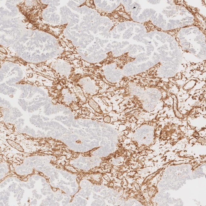 Immunohistochemistry (IHC) staining of human ovary cancer tissue using Caveolin-1 Monoclonal antibody (66067-1-Ig)