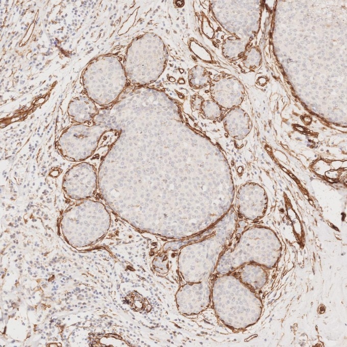 Immunohistochemistry (IHC) staining of human breast cancer tissue using Caveolin-1 Monoclonal antibody (66067-1-Ig)