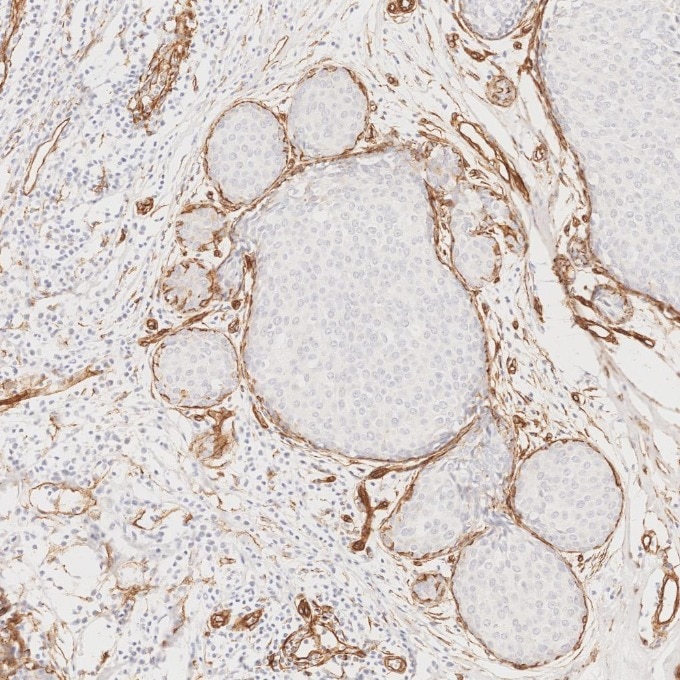 Immunohistochemistry (IHC) staining of human breast cancer tissue using Caveolin-1 Monoclonal antibody (66067-1-Ig)
