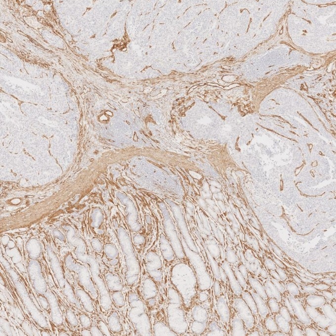 Immunohistochemistry (IHC) staining of human stomach cancer tissue using Caveolin-1 Monoclonal antibody (66067-1-Ig)