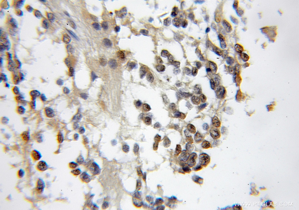 IHC staining of human gliomas using 11336-1-AP