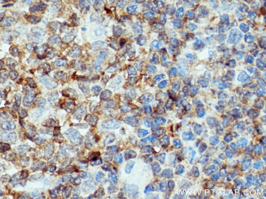 Immunohistochemistry (IHC) staining of human tonsillitis tissue using c-Cbl Polyclonal antibody (25818-1-AP)