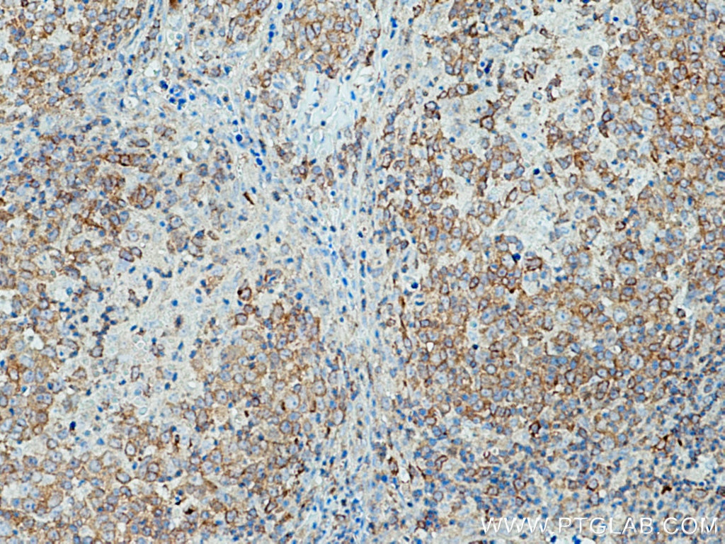 Immunohistochemistry (IHC) staining of human lymphoma tissue using c-Cbl Polyclonal antibody (25818-1-AP)