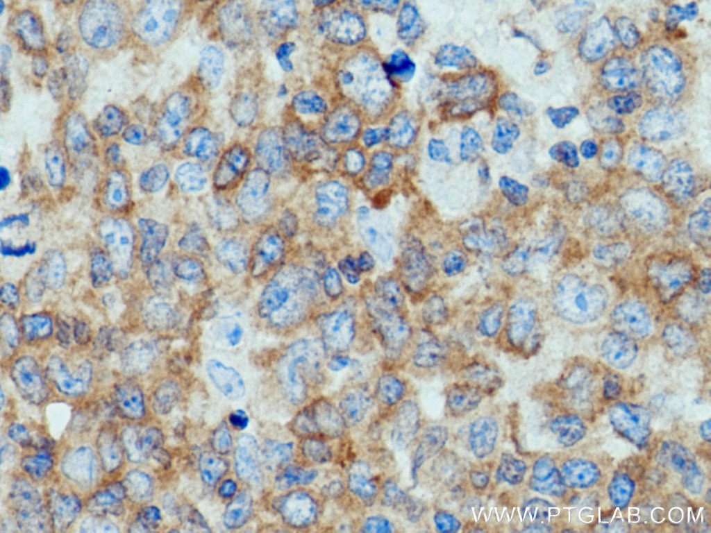 Immunohistochemistry (IHC) staining of human lymphoma tissue using c-Cbl Polyclonal antibody (25818-1-AP)