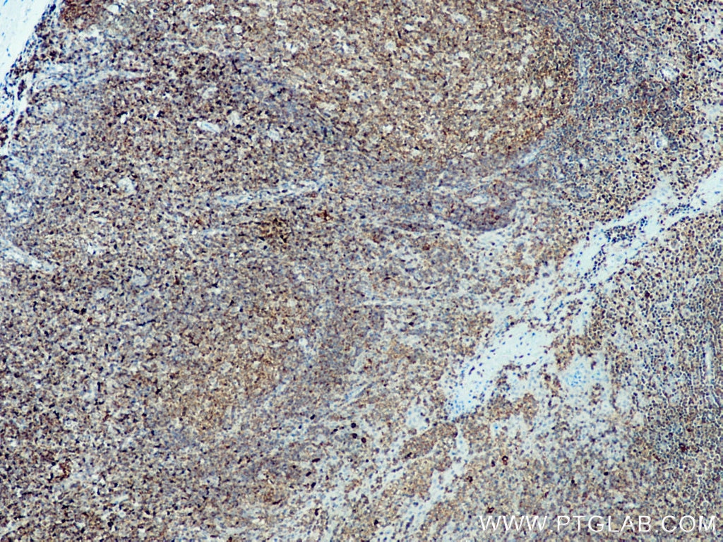 Immunohistochemistry (IHC) staining of human tonsillitis tissue using c-Cbl Polyclonal antibody (25818-1-AP)