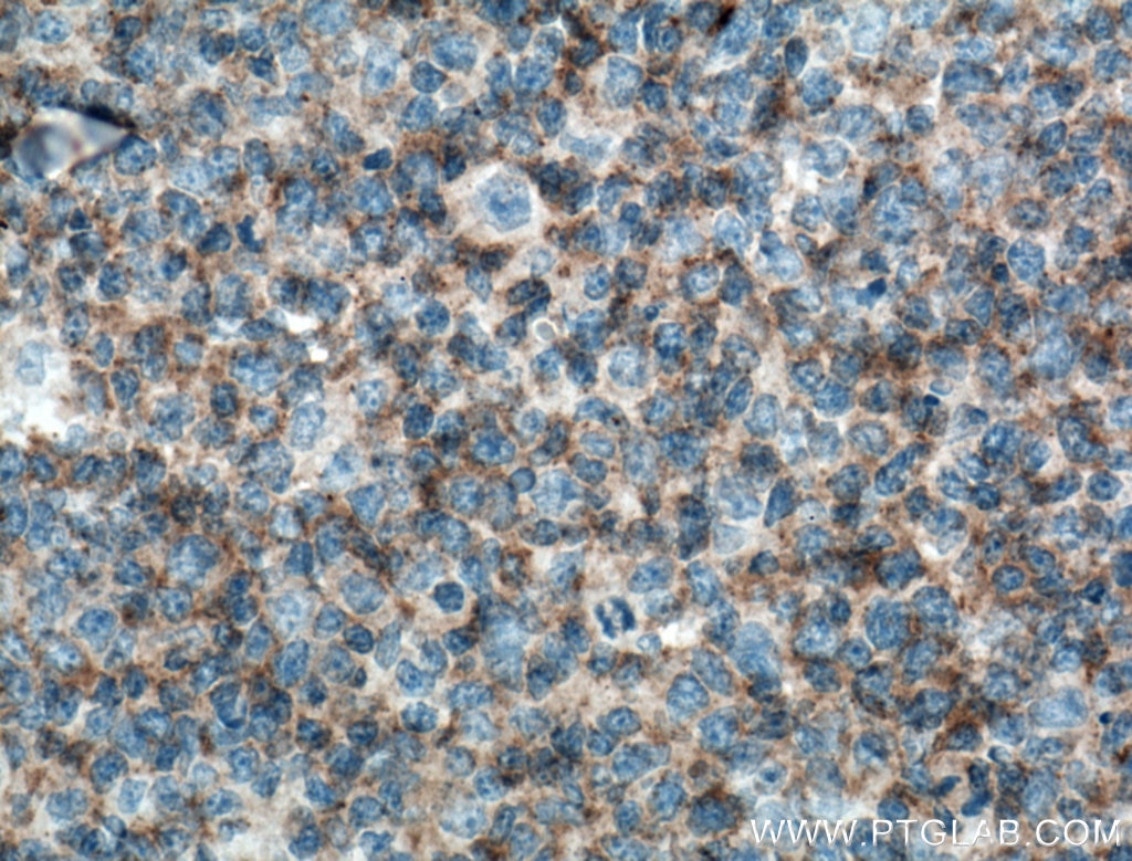 Immunohistochemistry (IHC) staining of human tonsillitis tissue using c-Cbl Monoclonal antibody (66576-1-Ig)