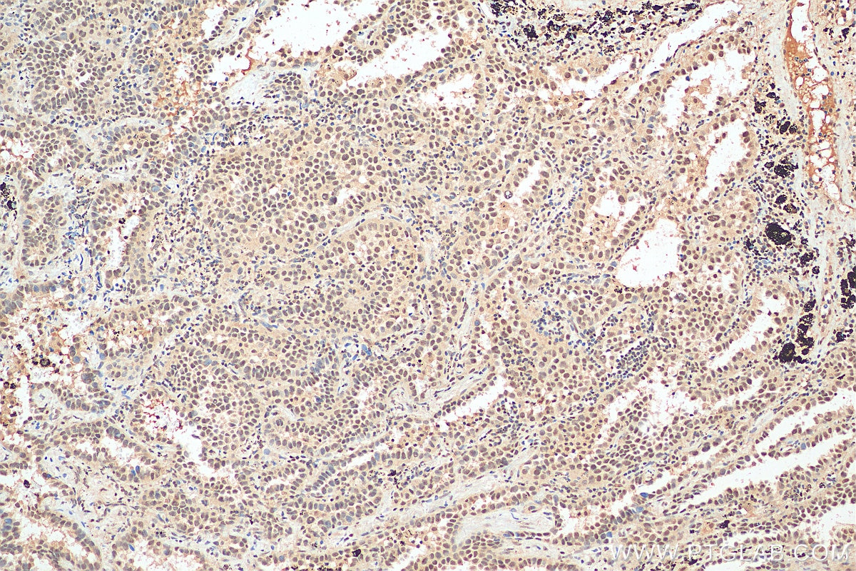 Immunohistochemistry (IHC) staining of human lung cancer tissue using CBLL1 Polyclonal antibody (21179-1-AP)