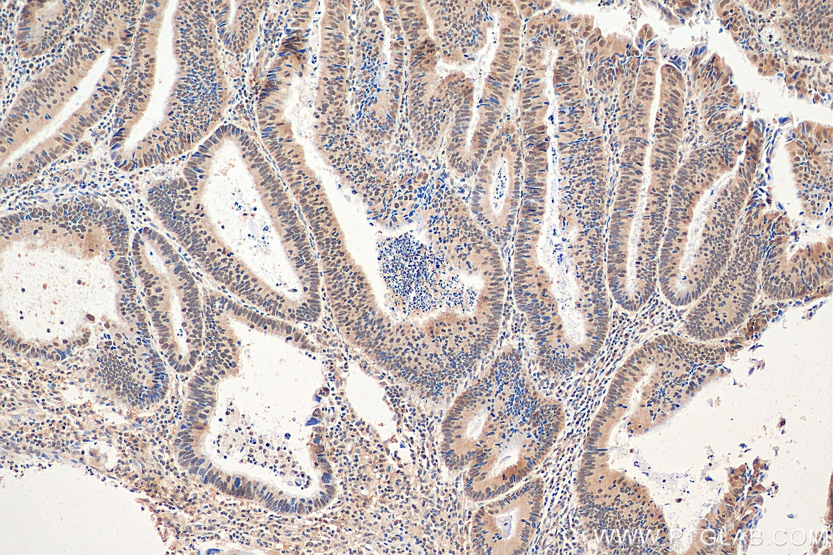 Immunohistochemistry (IHC) staining of human colon cancer tissue using CBLL1 Polyclonal antibody (21179-1-AP)