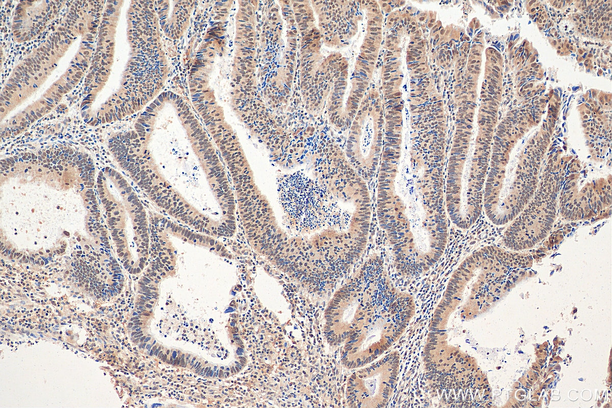 IHC staining of human colon cancer using 21179-1-AP