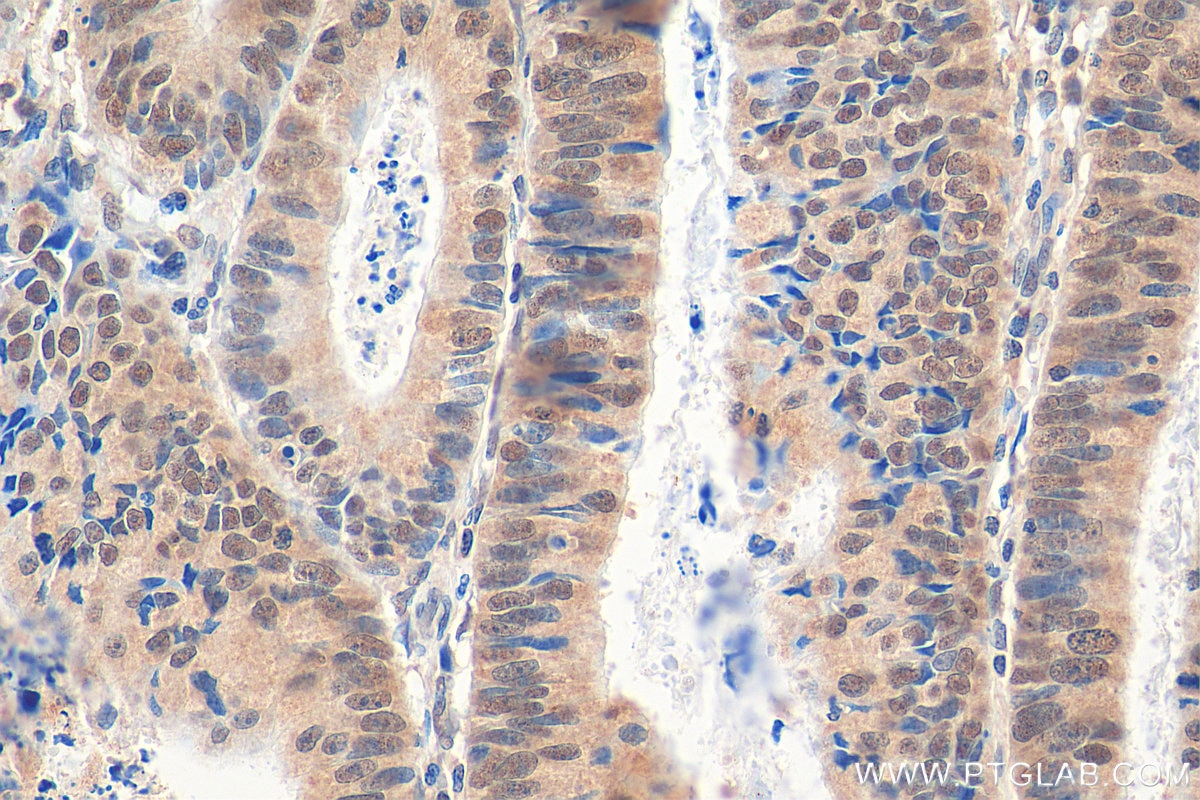 Immunohistochemistry (IHC) staining of human colon cancer tissue using CBLL1 Polyclonal antibody (21179-1-AP)