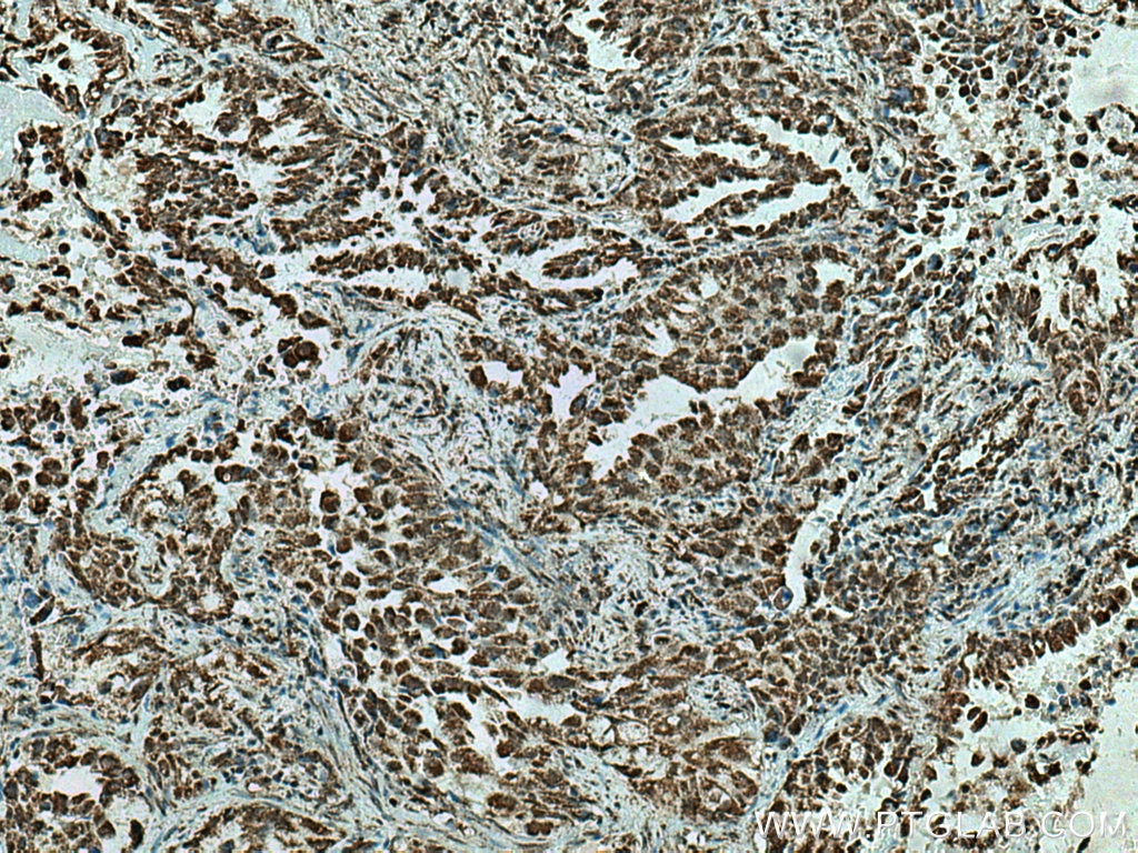 Immunohistochemistry (IHC) staining of human lung cancer tissue using CBLL1 Polyclonal antibody (29219-1-AP)