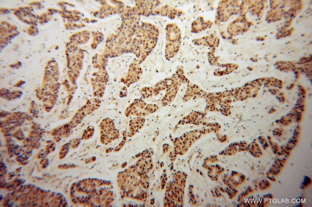 IHC staining of human breast cancer using 11149-1-AP