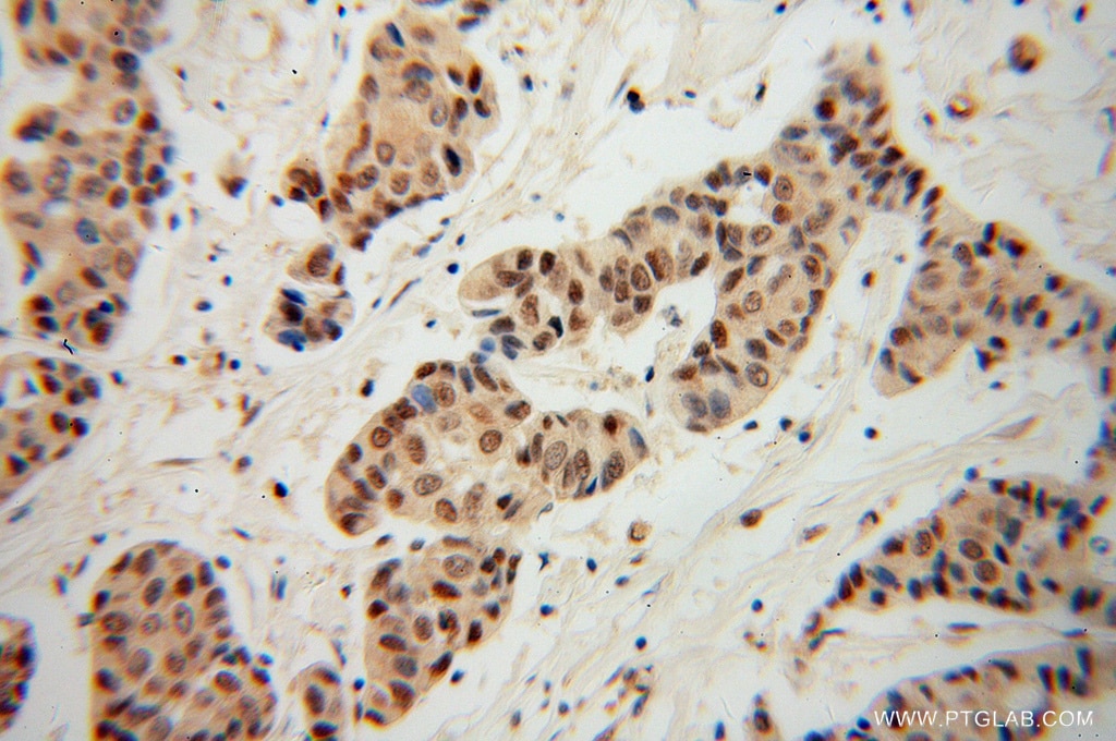 Immunohistochemistry (IHC) staining of human breast cancer tissue using EIF4E Polyclonal antibody (11149-1-AP)