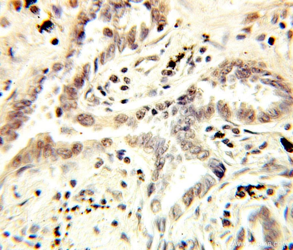 Immunohistochemistry (IHC) staining of human lung cancer tissue using NCBP1 Polyclonal antibody (10349-1-AP)