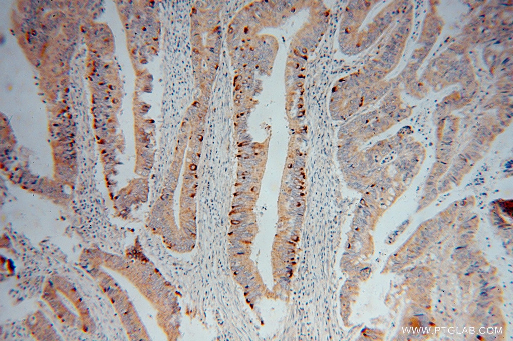 Immunohistochemistry (IHC) staining of human colon cancer tissue using CBR3 Polyclonal antibody (15619-1-AP)